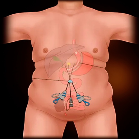 Single-port Gastric Sleeve